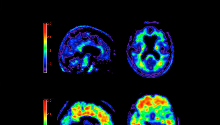 Prueba para la enfermedad de Alzheimer 