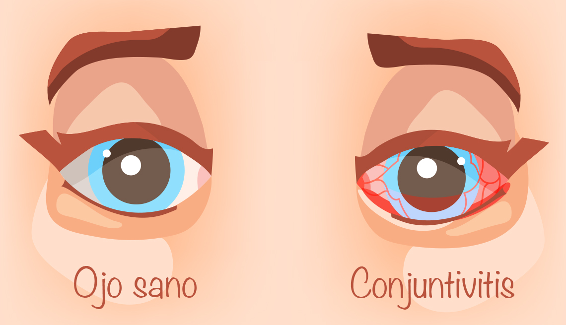 Lo que debes saber sobre la conjuntivitis