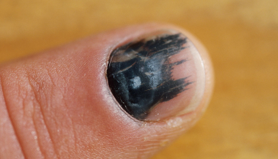 Top 130+ why nails become black