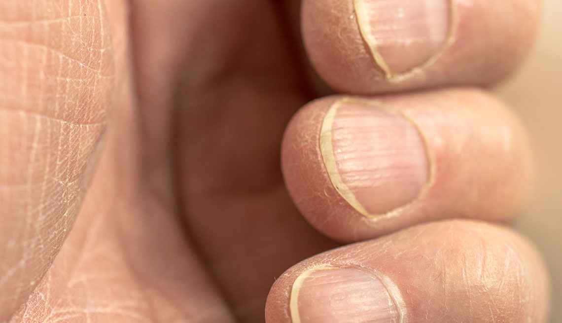 White Spots on Nails Causes and Treatment