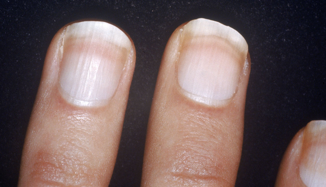 Details more than 68 nail tips turning white