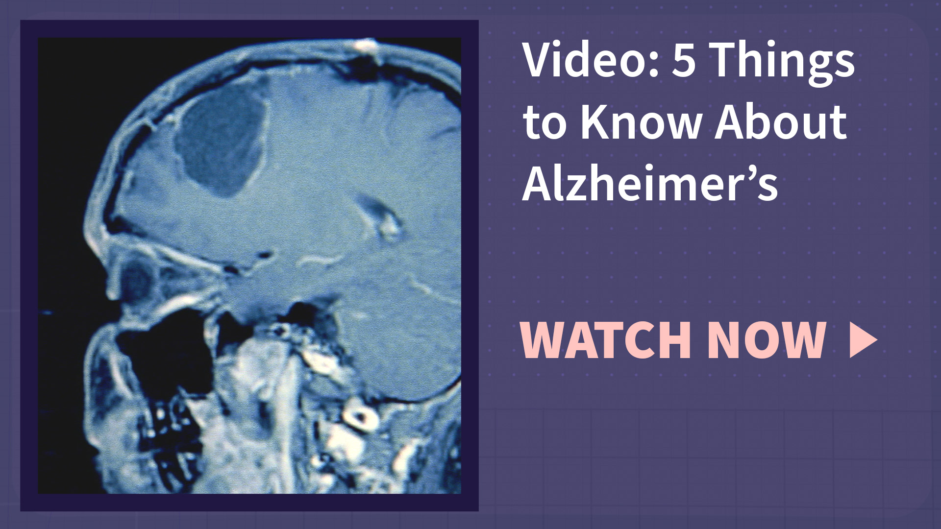 A human skull undergoing a brain scan with the text "video: 5 things to know about Alzheimer's" and "watch now"