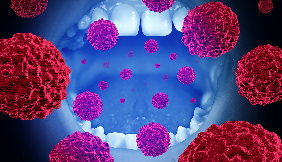 Gráfico sobre el cáncer oral Gráfico sobre el cáncer oral