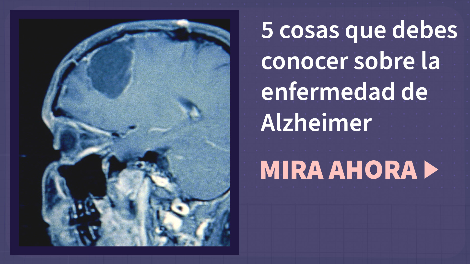 Un cráneo humano sometido a un escáner cerebral con el texto "vídeo: 5 cosas que debes conocer sobre la enfermedad de Alzheimer" y "mira ahora"