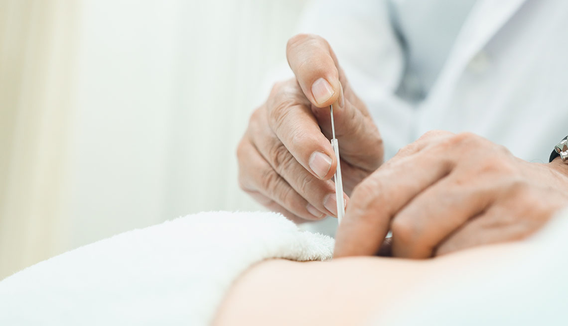 Acupuntura